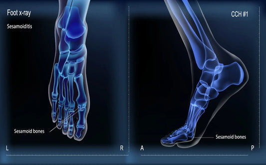 What Is Sesamoiditis?