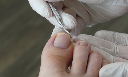 Treatments for Ingrown Toenails: Natural, Medical, and More