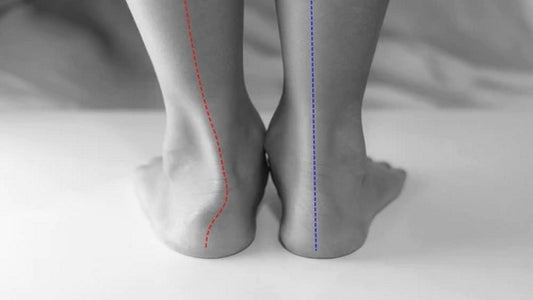 Are fallen arches a real foot problem, or just a label for chronically sore feet