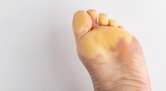 Scleroderma