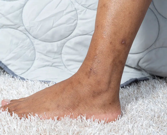 Visible Symptoms of Aging Legs